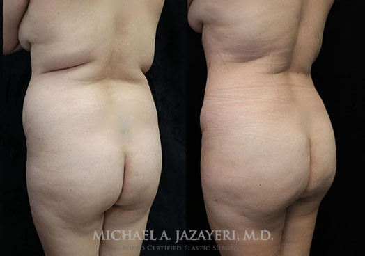 liposuction and fat transfer to butt before and after