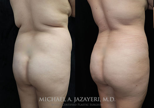 bbl before and after