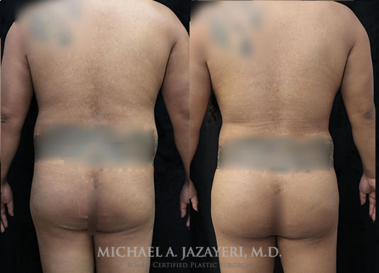 fat transfer to buttock before and after result
