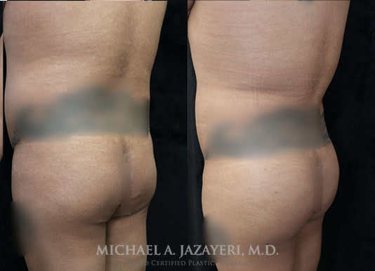 fat transfer to buttock before and after result