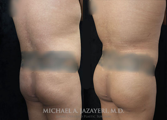 fat transfer to buttock before and after result