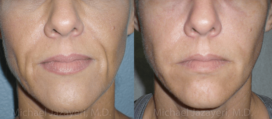 injectable Filler Before & After Photos