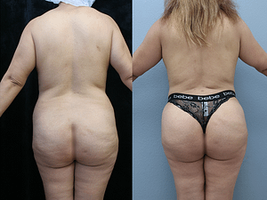 Brazilian Butt Lift Before & After Photos