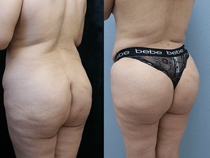 Brazilian Butt Lift Before & After Photos Left Side