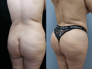 Brazilian Butt Lift Before & After Photos Right Side