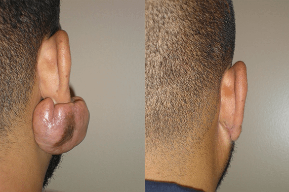 Keloid Removal Before & After Photos