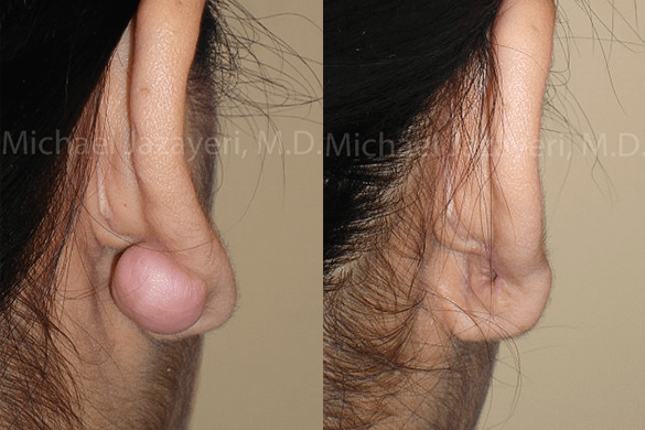 Keloid Removal Before & After Photos
