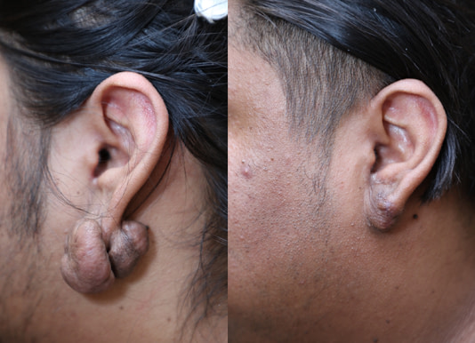Keloid Removal Before & After Photos
