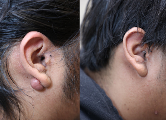 Keloid Removal Before & After Photos