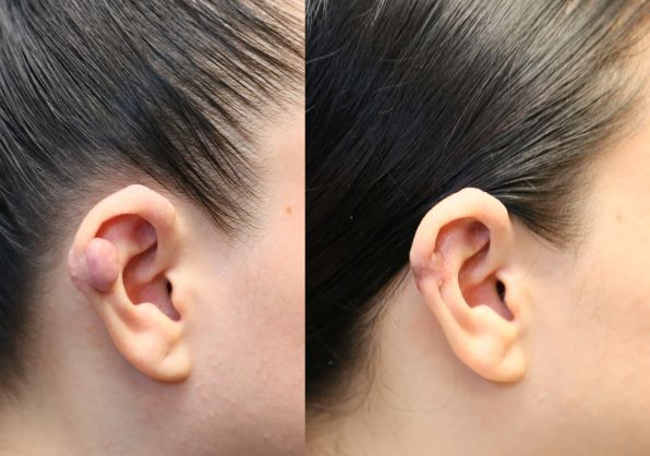Keloid Removal before and after