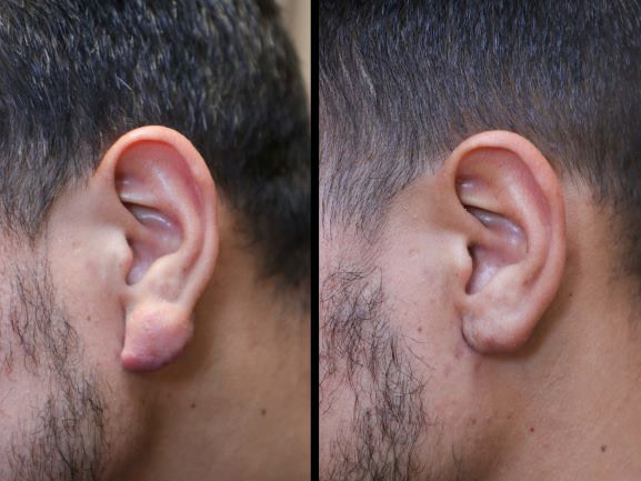 Keloid Removal Before and after