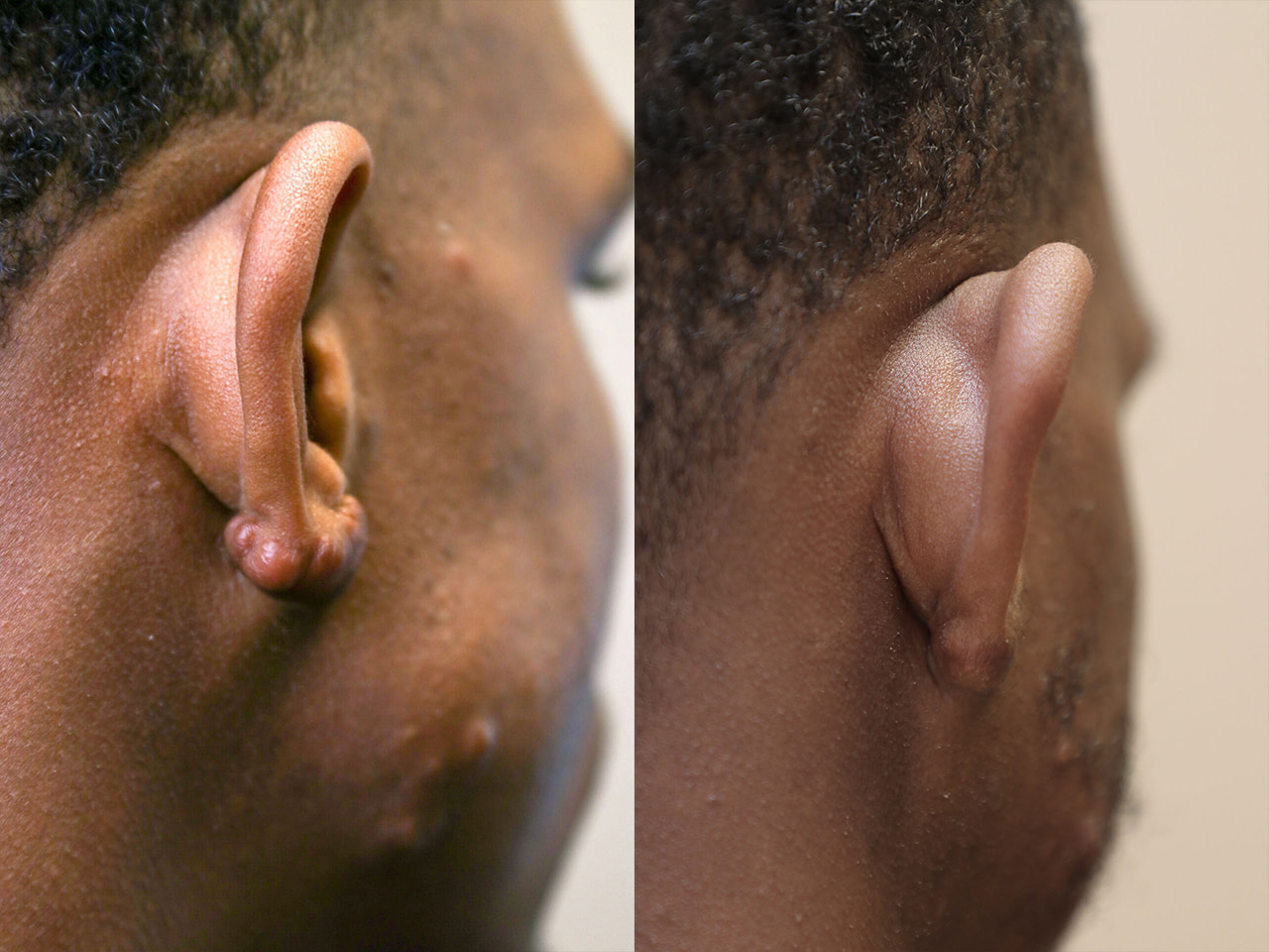 excision of keloid from the right earlobe.