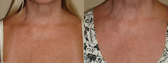 Laser Resurfacing Before & After Photos