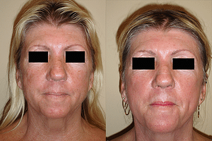 Laser Resurfacing Before & After Photos