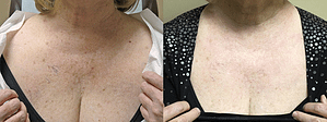 Laser Resurfacing Before & After Photos