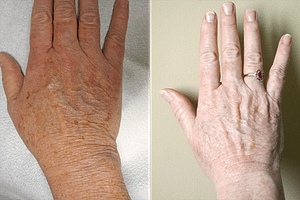 Laser Resurfacing Before & After Photos