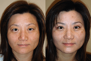 Laser Resurfacing Before & After Photos