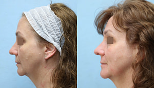 patient before and after laser resurfacing