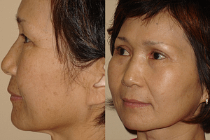 Laser Resurfacing Before & After Photos Left Side