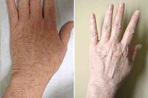 Laser Resurfacing Before & After Photos