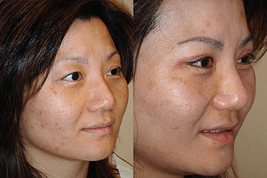 Laser Resurfacing Before & After Photos
