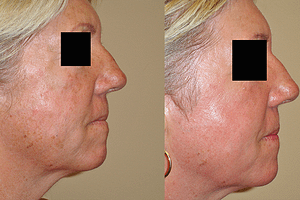 Laser Resurfacing Before & After Photos