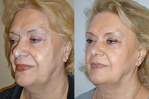 Laser Resurfacing Before & After Photos
