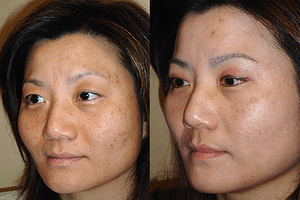 Laser Resurfacing Before & After Photos