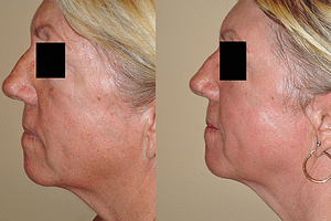 Laser Resurfacing Before & After Photos