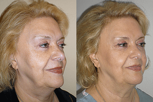 Laser Resurfacing Before & After Photos