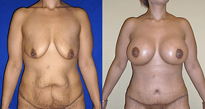 Breast Augmentation With Lift Before & After Photos