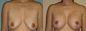 Breast Augmentation With Lift Before & After Photos