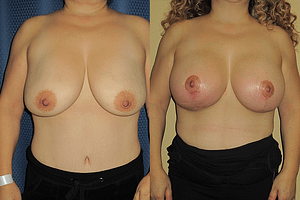 Breast Augmentation With Lift Before & After Photos