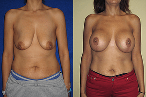 Breast Augmentation With Lift Before & After Photos