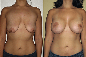 Breast Augmentation With Lift Before & After Photos Front