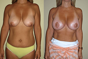 Breast Augmentation With Lift Before & After Photos