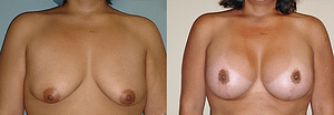 Breast Augmentation With Lift Before & After Photos