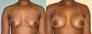 Breast Augmentation With Lift Before & After Photos