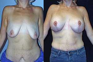 Breast Augmentation With Lift Before & After Photos