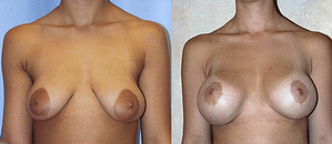 Breast Augmentation With Lift Before & After Photos Front