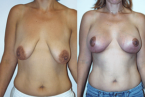 Breast Augmentation With Lift Before & After Photos