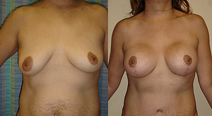 Breast Augmentation With Lift Before & After Photos