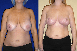 Breast Augmentation With Lift Before & After Photos