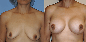 Breast Augmentation With Lift Before & After Photos