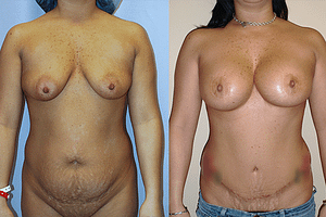 Breast Augmentation With Lift Before & After Photos