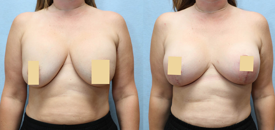 Breast Augmentation Lift Before & After Photos