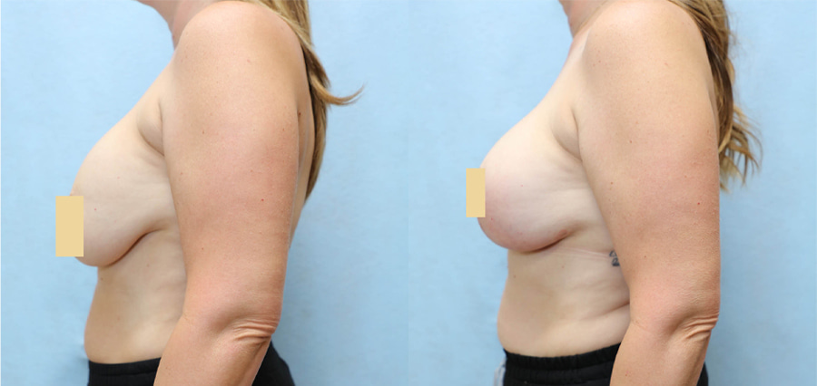 Breast Augmentation Lift Before & After Photos