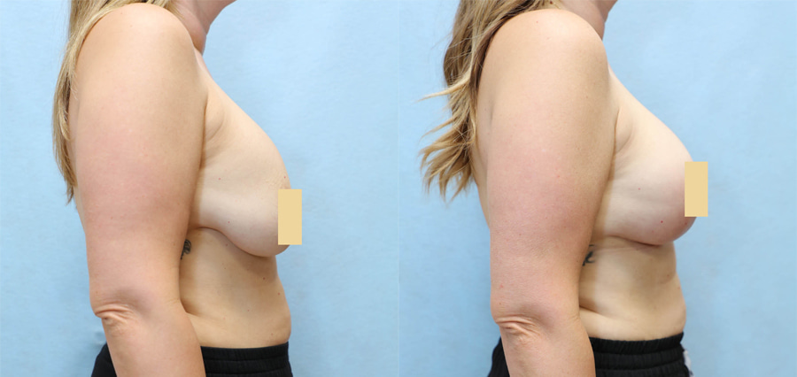 Breast Augmentation Lift Before & After Photos