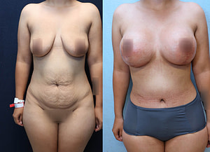 Breast Augmentation Lift Before & After Photos
