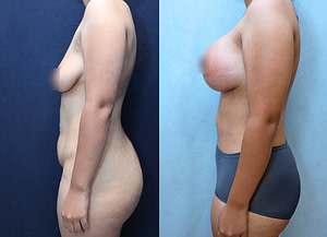 Breast Augmentation Lift Before & After Photos
